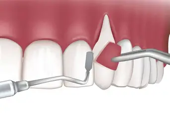 Gum Disease & Flap Surgery